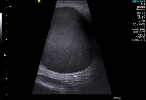Ultrasound Examination Of The Breast Reveals A Hypoechoic Giant Cystic