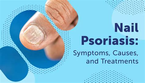 Details More Than 136 Psoriatic Arthritis Nail Pitting Super Hot Ceg