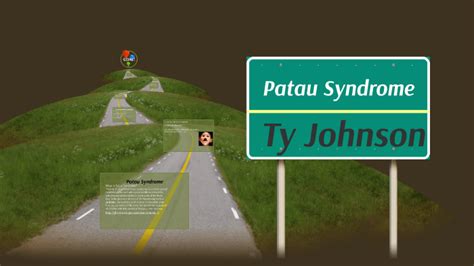 Patau Syndrome By Ty Johnson