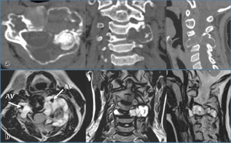 Ct And Mri Sections Of An Aneurysmal Bone Cyst Of The C Vertebra In A Download Scientific