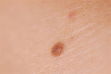 Closeup Brown Mole On Caucasian Woman Skin Stock Photo Download Image