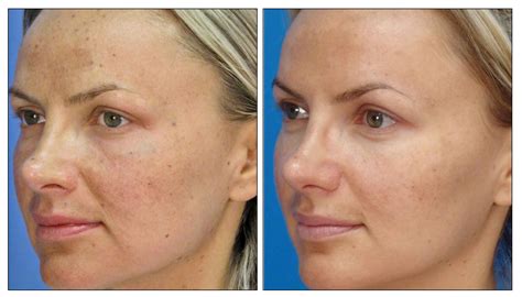 Skin Rejuvenation Treatment Laser Creations