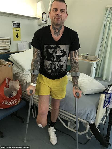 Man Who Lost Half His Leg Says Doctors Have Refused To Save His Stump