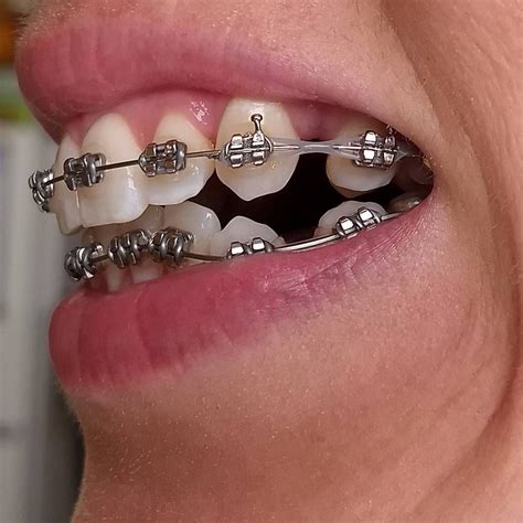 Braces Girlswithbraces Metalbraces Powerchain Orthodontie
