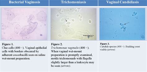 Accuracy Of Self Collected Vaginal Swabs In The Diagnosis Of Bacterial Vaginosis Vaginal