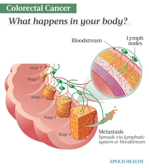 The Essential Guide To Colorectal Cancer Symptoms Causes Treatments