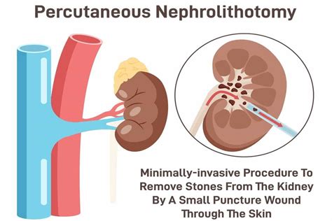 Percutaneous Nephrolithotomy Pcnl Cost In India And More