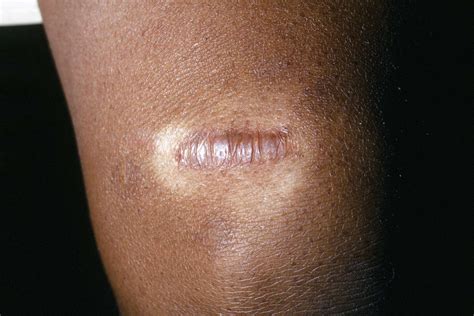 Keloid Scars Risks Causes Prevention And Treatment