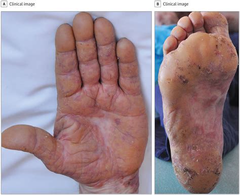 Association Of Transient Palmoplantar Keratoderma With Clinical And