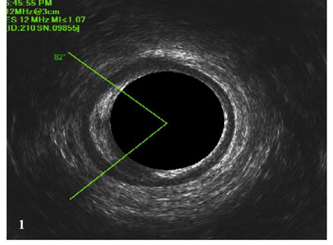 Two Dimensional Endoanal Ultrasound Showing 82° Eas Lesion Download Scientific Diagram