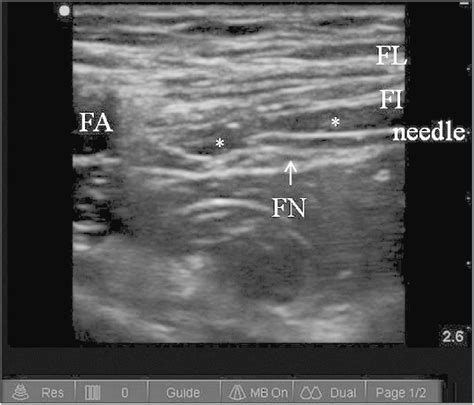 Transverse Sonogram Of The Femoral Nerve After Injection Of A Local