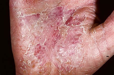 Weeping Eczema On Hands Pictures 41 Photos And Images