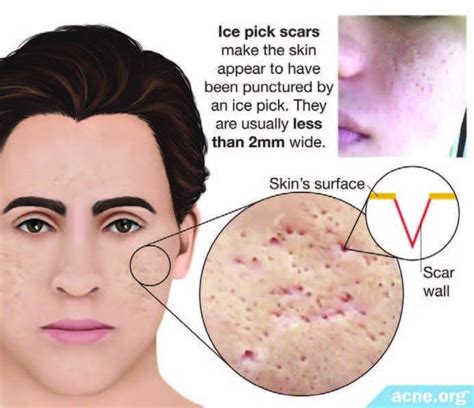 Acne Scars Skinpen Precision By Crown Aesthetics