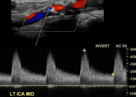 The NASCET Carotid Endarterectomy For Symptomatic Stenosis Classics