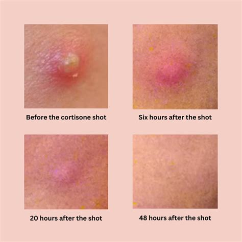 Emergency Cortisone Shots For Acne A First Hand Experience Of The