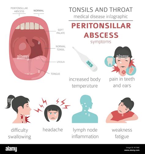 Tonsils And Throat Diseases Peritonsillar Abscess Symptoms Treatment