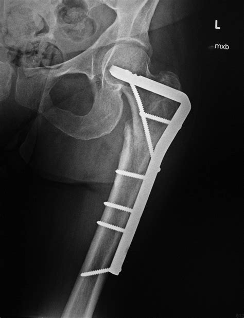 Medical Apparatus Imaging Guide Fracture Fixation