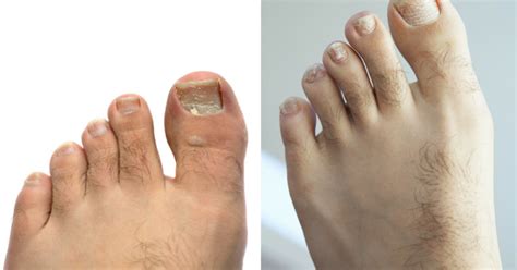 Psoriasis On The Feet Why Is It So Important To Treat It On Time Cureup