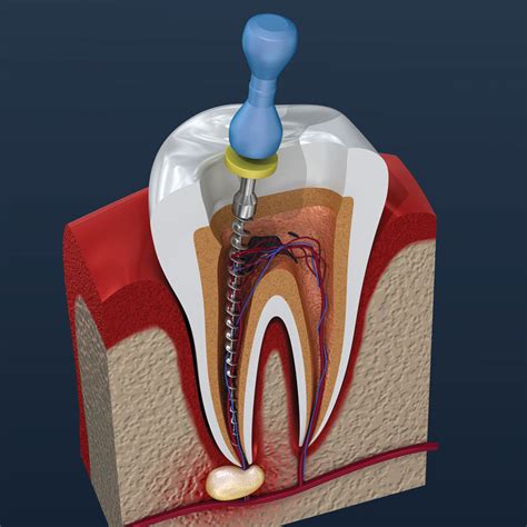 endodontics archives page 7 of 7 dentistry ebooks