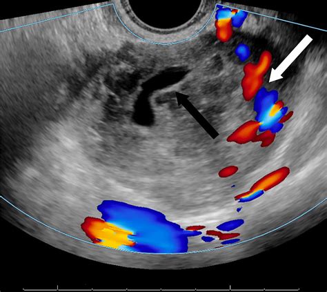Week Ectopic Pregnancy Ultrasound