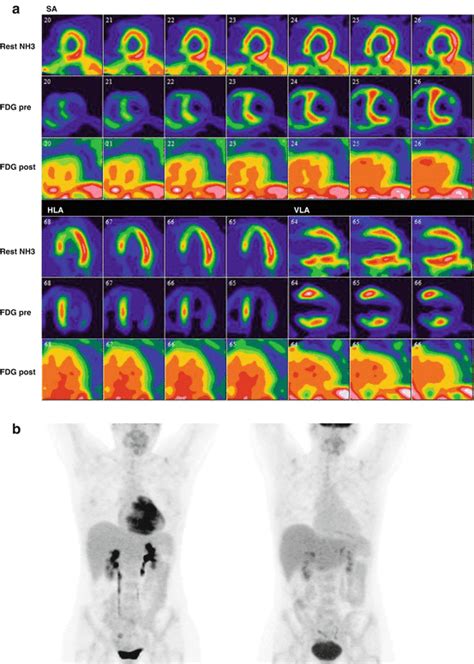 Role Of Petct In Assessing Cardiac Sarcoidosis Radiology Key