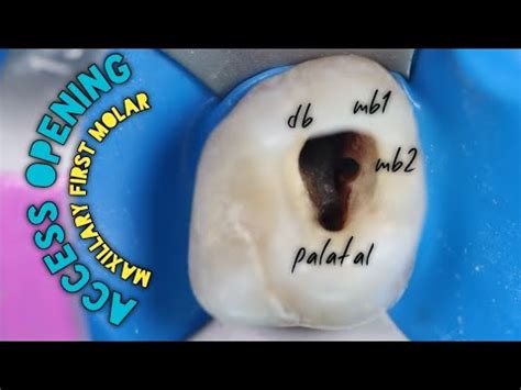 Access Opening Of Maxillary First Molar How To Easily Locate