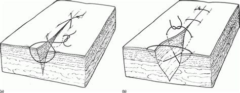 9 Selection Of Suture Materials Suture Patterns And Drains For Wound