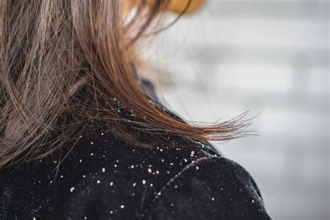 Can Stress Cause Dandruff Reality Paper