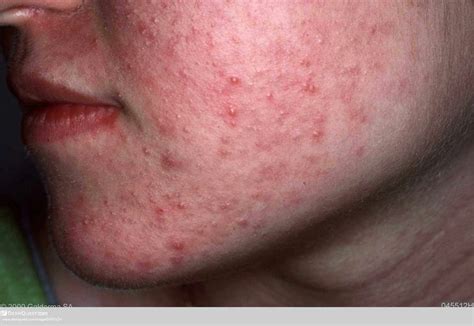 Pityrosporum Folliculitis Malassezia Yeast And Acne