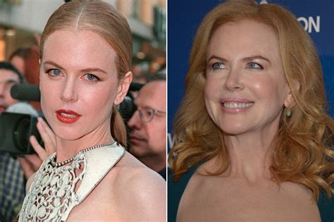 Nicole Kidman Et La Chirurgie Esthétique - Nicole Kidman