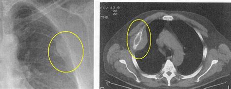 Bone Metastases Images And Xrays