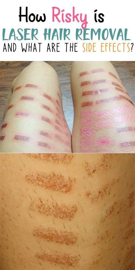 How Risky Is Laser Hair Removal What Are The Side Effects Laser Hair Removal Hair Removal