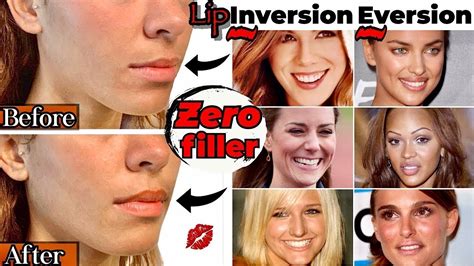 Botox Lip Flip Before And Afters Everything You Need To Know Youtube