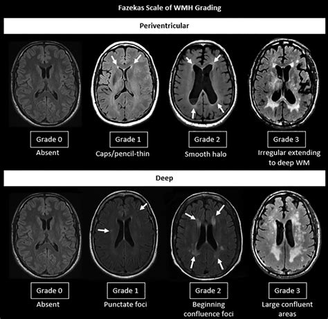Small Vessel Disease A Marker Of Brain Health What The Radiologist