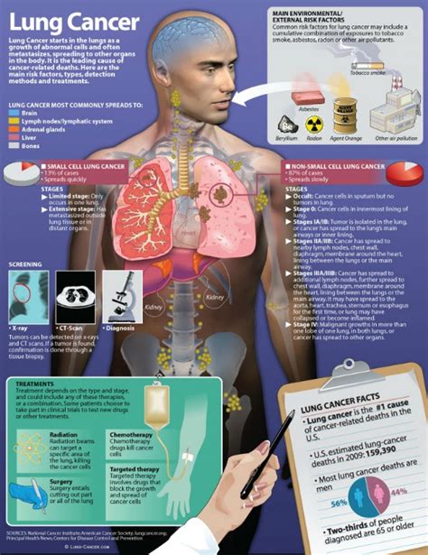 Facts about the most common cancer symptoms and signs, which include lumps, blood in stool or urine, nonhealing sores, unexplained weight loss, fever, swollen what are 18 signs and symptoms of cancer? Lung Cancer Infographic | Visual.ly