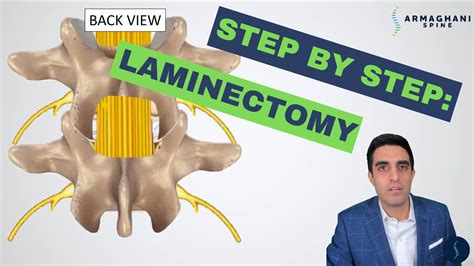 Step By Step How To Perform A Lumbar Laminectomy Youtube