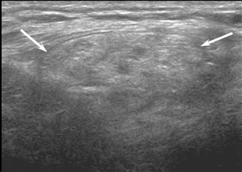 Sonographic Findings Of Groin Masses Yang 2007 Journal Of