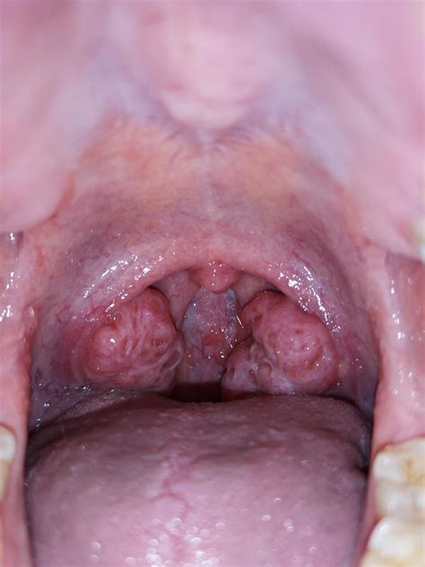 Anyone Know Why My Tonsils Are So Big And Porous They Dont Hurt But