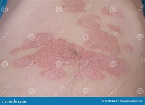 The Man With A Disease Psoriasispsoriasis On The Body Stock Photo