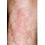 Urticaria  Stock Image C026/9174 Science Photo Library