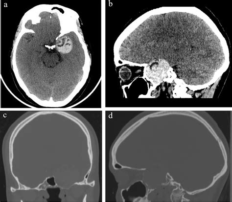 Figure 1 From Parasellar Epidermoid Cyst With Unique Radiological