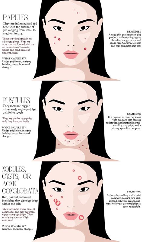 5 Different Types Of Acne And How To Treat Them Previewph Types Of