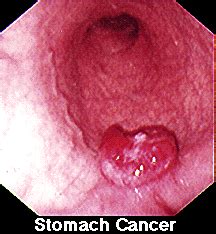 Bonjour, j'ai 20 ans et je voulais savoir si à mon âge j'ai des risques de contracter un cancer de l'estomac ? سرطان المعدة ، اعراض سرطان المعدة ، طرق علاج سرطان المعدة