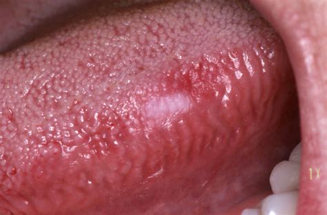 The chance of survival is very good at this stage. Oral Cancer Symptoms- Signs To Know - Dentist Says