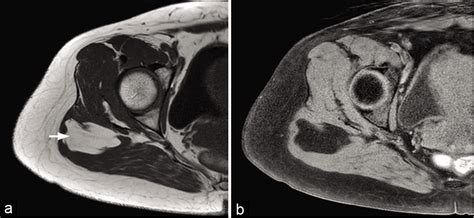Tumors And Pseudotumors Of The Soft Tissues Imaging Semiology And