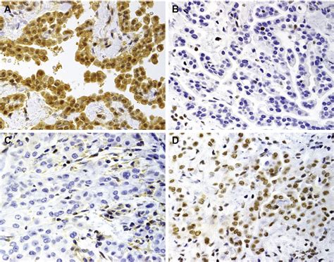 A subspecialty of histology known as immunohistochemistry uses special stains to reveal more details about a tumor. Immunohistochemical detection of MTAP and BAP1 protein ...