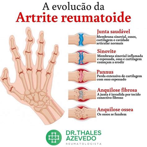 Artrite Reumatoide Causa Sintomas Diagnóstico E Tratamento