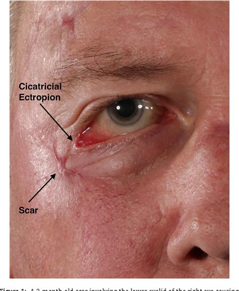 Figure 1 From Cicatricial Ectropion After Wound Closure Of Facial