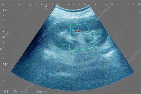 Renal Lithiasis Ultrasound Stock Image C0268798 Science Photo