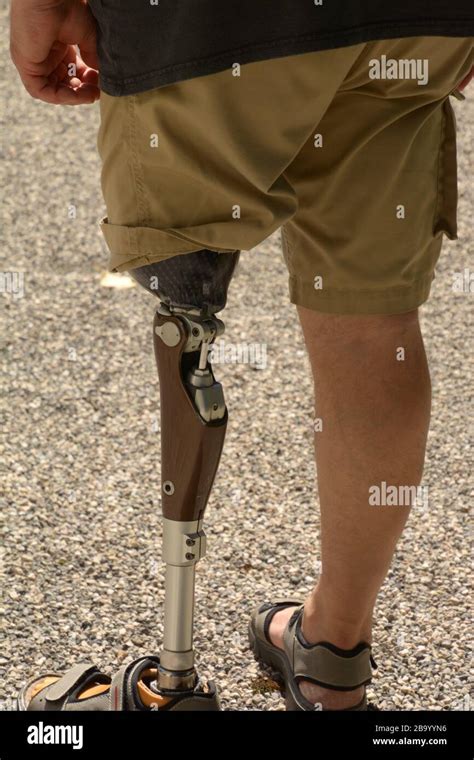 Left Leg Prosthesis Self Assured Man Wearing Shorts Man With Amputee